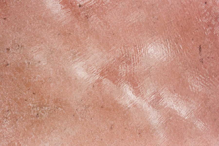 Skin cancer