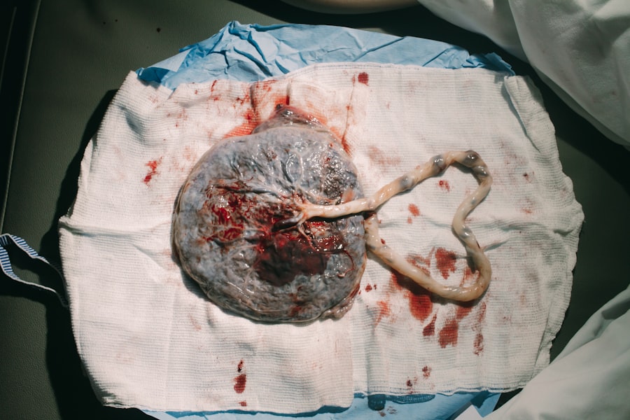 Testicular tumor