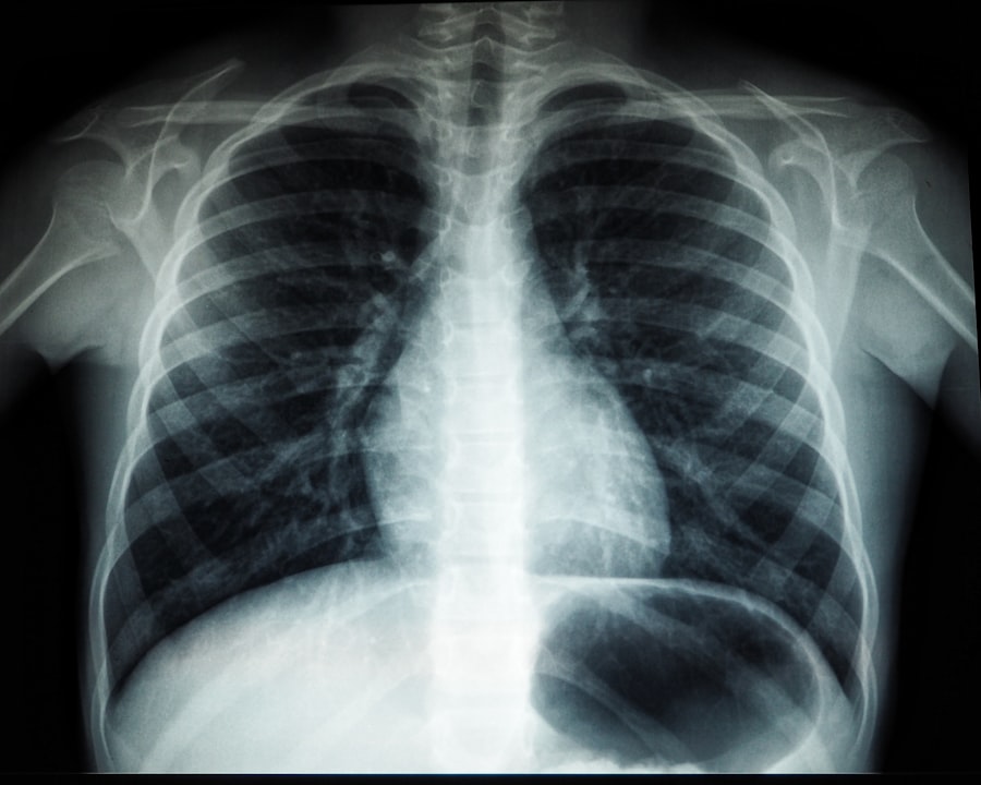 Chest X-ray