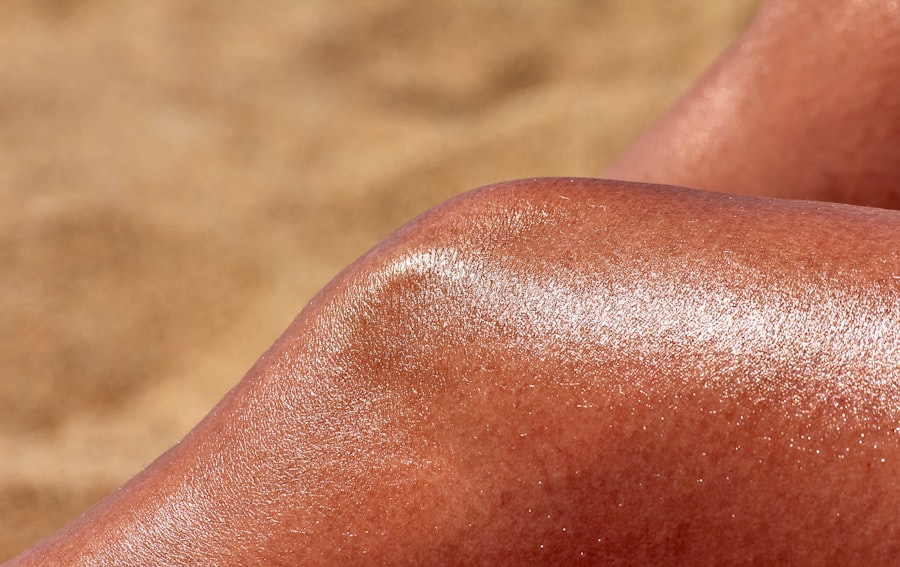 Skin cancer
