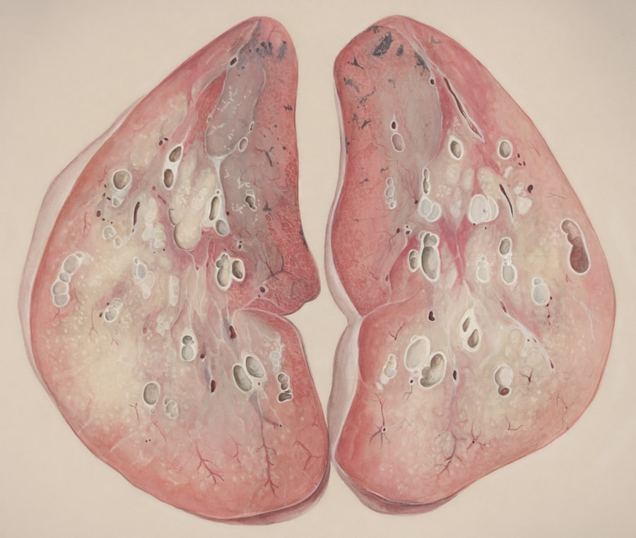 Lung cancer
