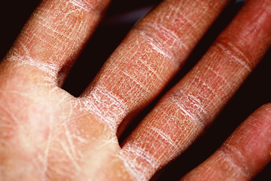 Skin lesion