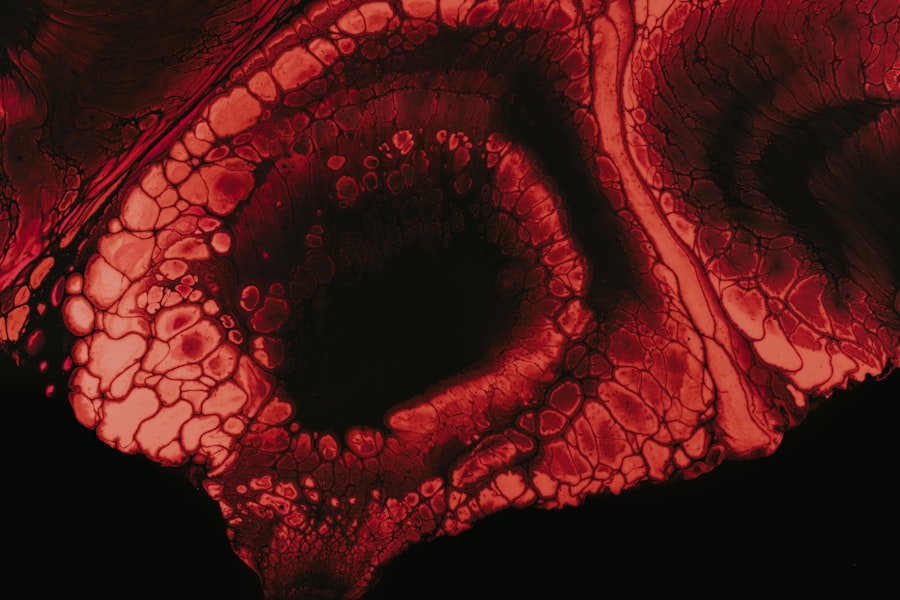 Blocked artery
