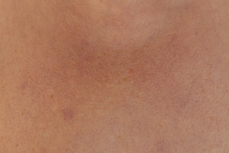 Photo Skin lesion