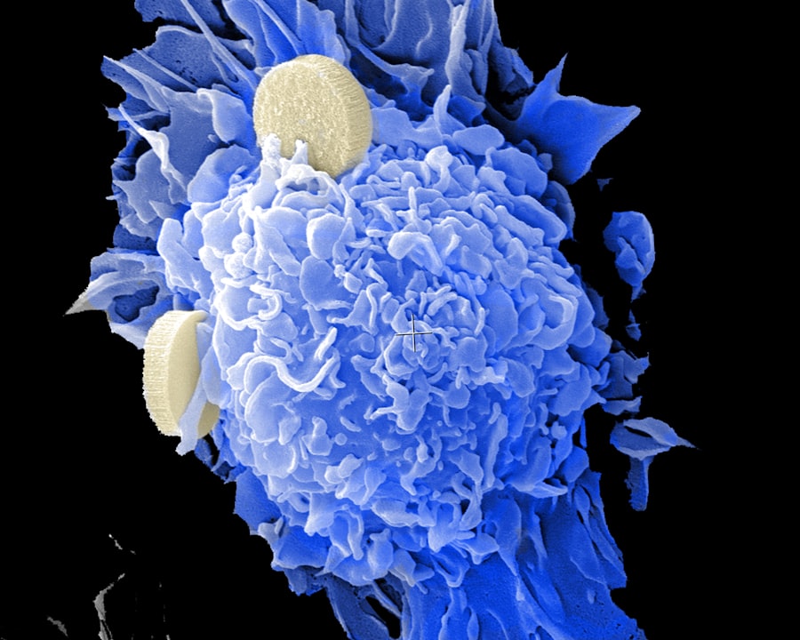 Photo Cancer staging