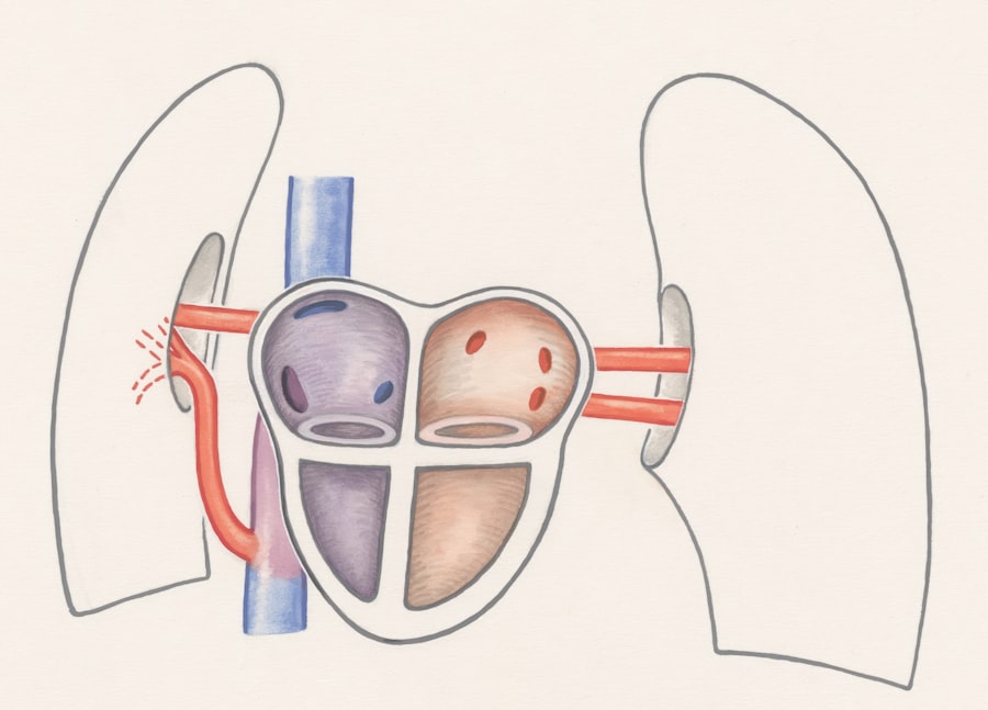 Photo Blocked artery