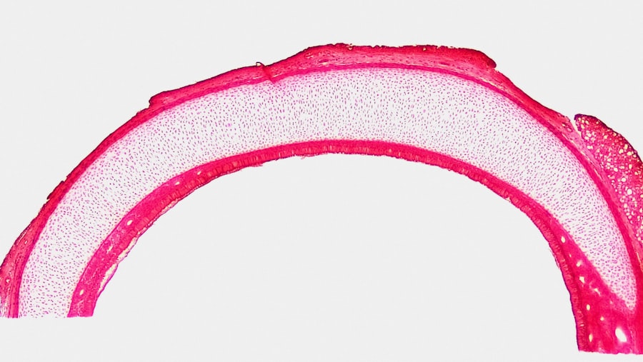 Photo Stent placement